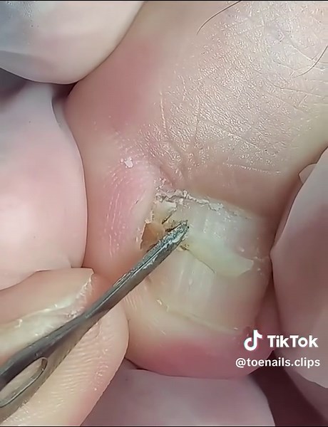 #toenailfungus #satisfying #nails #toenailremoval #toenail