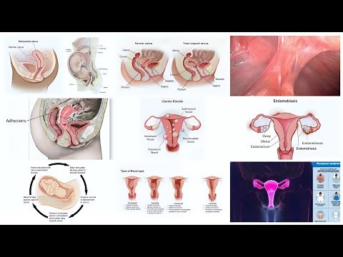 A Comprehensive Guide to Understanding Retroverted Uterus : Causes , Symptoms and Facts