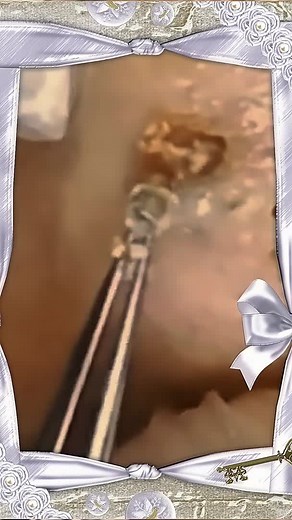 #pimple #pimplepop #squeezeyuk #foryou #fyp #satisfyingvideo #squeeze #acne #blackheard