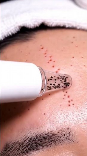 “Deep Pore Vacuum Test — Visible Extraction Shots!”