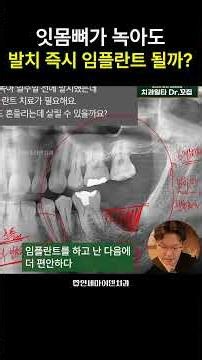 잇몸뼈가 없는데 발치 즉시 임플란트가 가능하다고요?