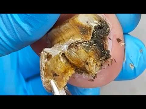 Half Of My Toenails Are Moldy, Trim Them Step By Step!【Xue Yidao】