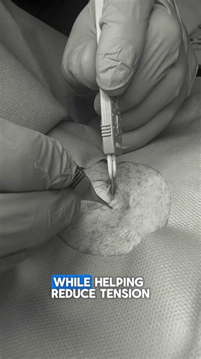 Hardened Cheese Cyst Removal | Contour Dermatology #cystremoval