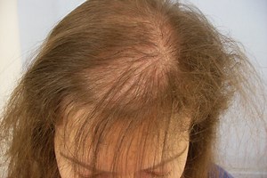 Female alopecia: what it is and how to treat it | Emergency Live