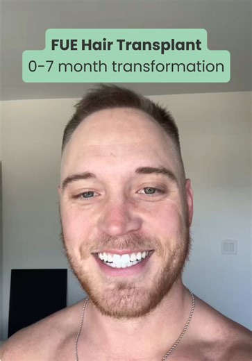 Transformación del cabello de Jimmy en 7 meses