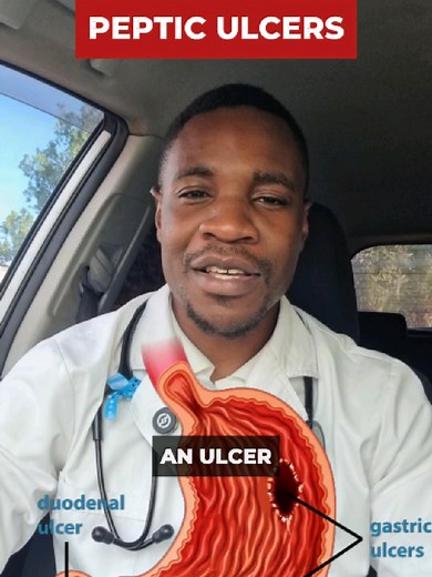 Understanding Peptic Ulcers: What Are Gases?