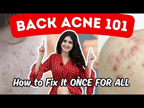 How To Get Rid Of BACK ACNE (At Home) - 3 Best Back Acne Treatments