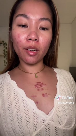 Keloid Skincare Routine for Acne Prone Skin: Pimple Patch Peel