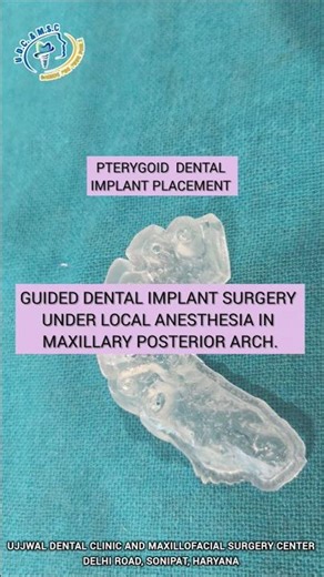 pterygoid dental implant placement using guided surgery under local anesthesia.#education #bioline