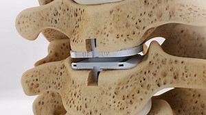 prodisc C Surgical Technique Animation \n(2021)