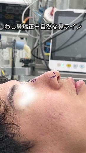 こちらは手術室で撮影されたリアルなビフォーアフター動画です📹