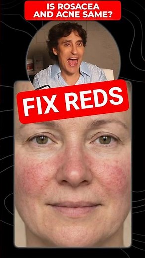 Fix Rosacea and Red Skin Flares