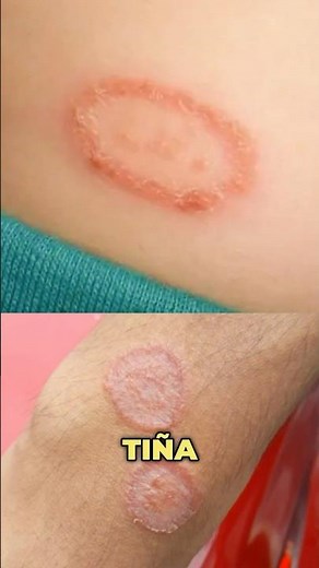 Treatment for tinea corporis #drwilsondelgado #treatment #tinna #cure