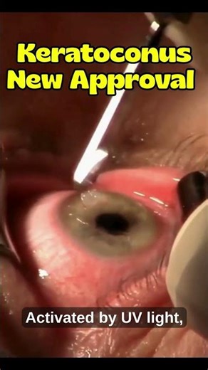 FDA approval for progressive keratoconus
