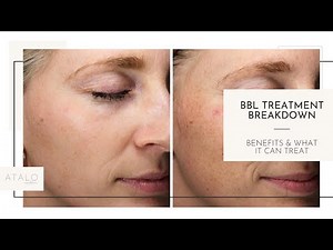 What Does BBL Help With? I Acne, Rosacea, Sun Damage