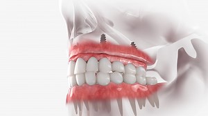 We can provide the Gold Standard in Tooth Replacement options, Full Arch Dental Implants! Are you a candidate? | Center for Dentistry