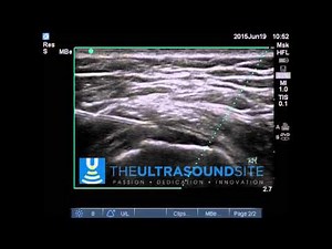 US guided trochanteric bursal Injection shallow angle