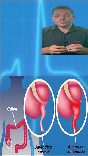 APENDICITE - CAUSAS, SINTOMAS E TRATAMENTO - APENDICITE AGUDA - #apendicite #dordebarriga