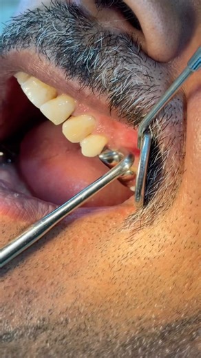 Easy Dental Cap removal technique 🦷 #dentist #dentalprosthesis #removal #dentalstudent #viral #new