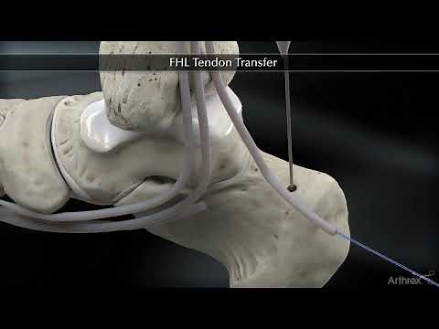 Transfert du long fléchisseur de l'hallux (FHL) - Rupture du tendon d'Achille - Dr Simon Tournemine