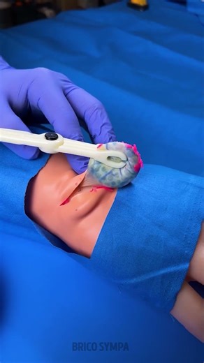 Procédure satisfaisante : retrait d’un kyste à la main 🔥🖐️✨
