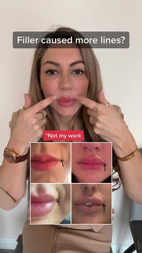 Has it happened to you? 💗 #lips #lipfiller #lipfillers #fillerlips #lipinjections #lipinjector #lipenhancement #lipaugmentation #cupidsbow #hydratedlips #plumplips #fillers #filler #revolaxlips #nurseinjector #nurseinjectors #cosmeticnurse #medicalaesthetics #aesthetics