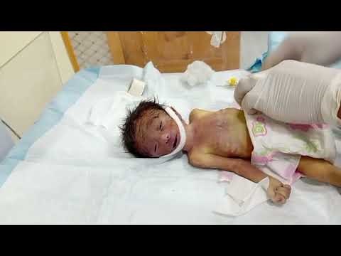 Neoboran Baby | Understanding Infant Loss: Causes, Support & Prevention