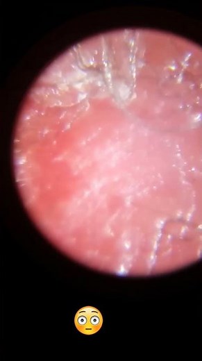 This is what the Real Morgellons looks like!
