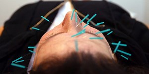 A neurologist explains why acupuncture is useless