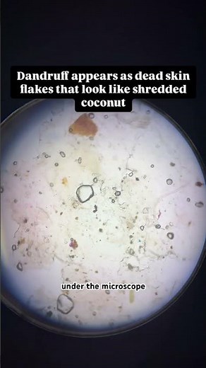 “Microscopic View of Dandruff: A Closer Look at Scalp Flakes #microscopevibes #ytshorts