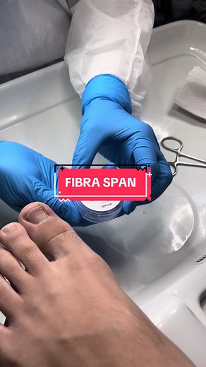 Tratamiento con FIBRA SPAN®️ para Uñas Curvadas