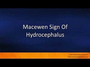 Pronunciation of the word(s) "Macewen Sign Of Hydrocephalus".