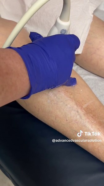 VNUS Grade Venous Doppler: Reflux study of the veins 🩸#veins #doctor #medicine #vascular
