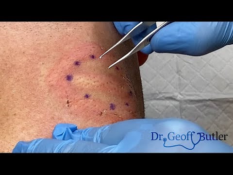 Removal of Scar tissue and ultimately a lipoma