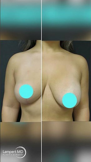 EXPLANT & BREAST LIFT - 7 Months Post Op