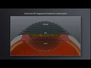 Catalys Precision Laser System
