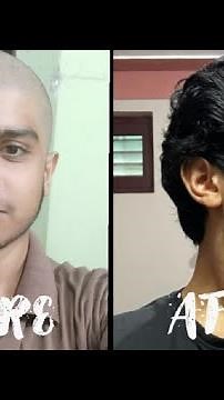 Hair growth time lapse of 5 months (140 days ) Men.