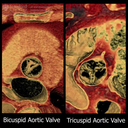 #3dimaging #anatomy #tavr | Stanford 3D & Quantitative Imaging Laboratory