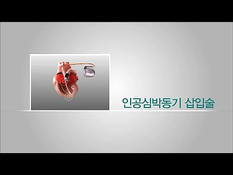 인공심박동기삽입술