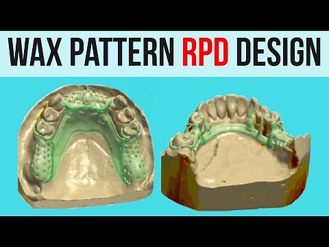 Wax pattern construction of RPD Design