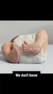 Club foot. What is it & how is it treated? #pediatricphysiotherapy #clubfoot #clubfootinfant #baby