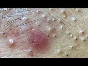 Relaxing every day with acne spa blackheads spa