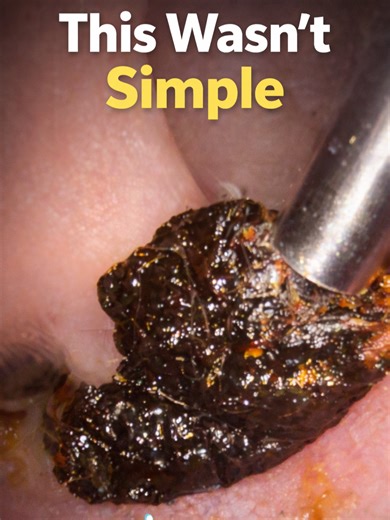 Three Unique Ear Wax Removals with Surprising Results