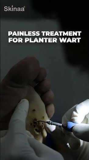 How To Remove Plantar Warts: Understanding, Treating, and Preventing Foot Warts #skinaa_clinic