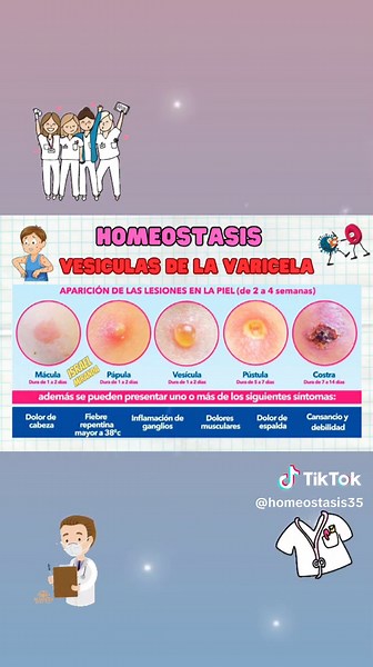 Etapas y síntomas de la varicela en niños y adultos
