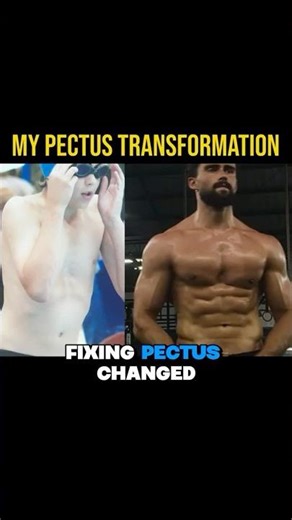 FIXING PECTUS IS LIFE CHANGING