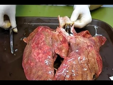 Video muestra el efecto de 60 cigarros en los pulmones