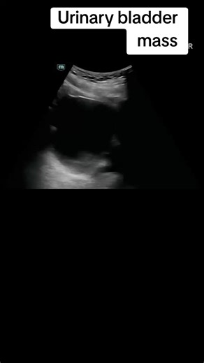 ‏Urinary bladder mass on ultrasound #ultrasound #radiology #radiologist