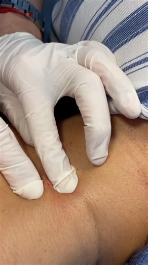 Understanding Epidermoid Cysts: Causes and Treatments