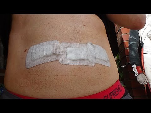 Leistenbruch OP Erlebnißbericht